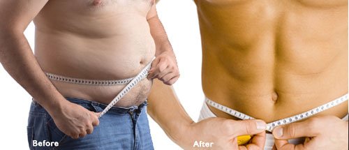 Body Contouring Liposuction